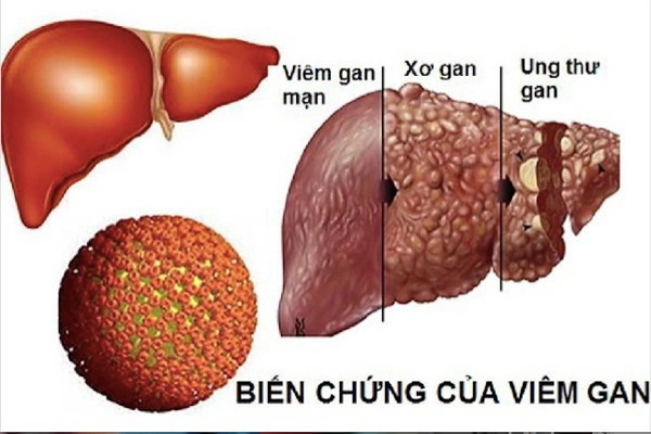 Viêm gan B có dẫn tới ung thư gan không? Phòng ngừa ra sao?